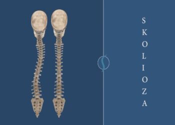 Skolioza, deformimi që po njeh rritje tek fëmijët. Nis depistimi në të gjitha shkollat