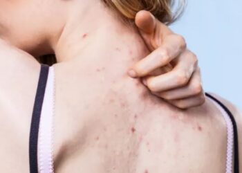 Çfarë është Hidradenitis suppurativa, sëmundja kronike e lëkurës dhe si ndikon në jetën e atyre që prek