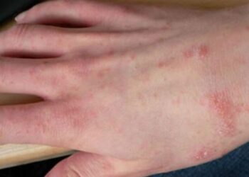 Zgjebja/ Ministria e Shëndetësisë qetëson qytetarët: Nuk ka shpërthim epidemiologjik!