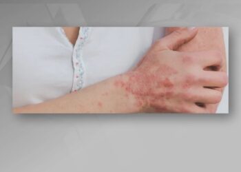 Rreth 700 të infektuar me zgjebe në Kosovë shtohen rastet edhe në Shqipëri