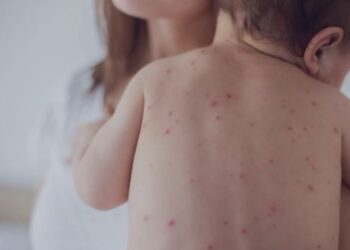 Rriten rastet me fruth, OBSH: Në 2023 u regjistruan 20% më shumë infektime