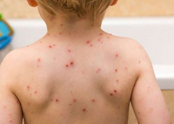 Alarmi nga fruthi/ Shtohen rastet në Shqipëri, ISHP: Vaksinimi ul përhapjen