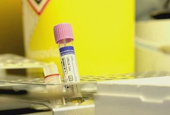 Lia e majmunit në Shqipëri, si u zbulua 31-vjeçari i prekur, shenjat dhe trajtimi i tij