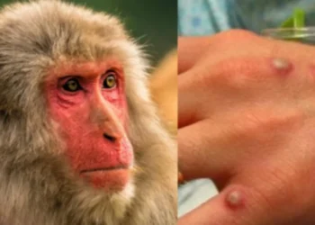 Shfaqet lija e majmunit në Shqipëri, identifikohet rasti i parë