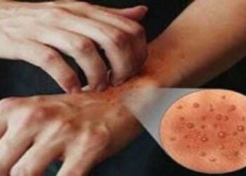 Italia në alarm, zgjebja po përhapet me shpejtësi, rastet u shtuan me 750% në tre vjet