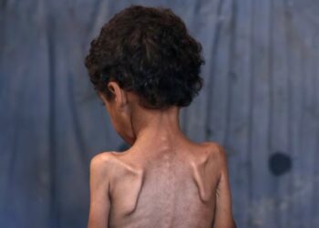 Trondit kreu i “Save the Children”: Fëmijët e uritur në Gaza nuk kanë fuqi as të qajnë!