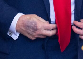 Mavijosja në dorën e Trump, çfarë do të thotë? Cilat janë problemet shëndetësore që…