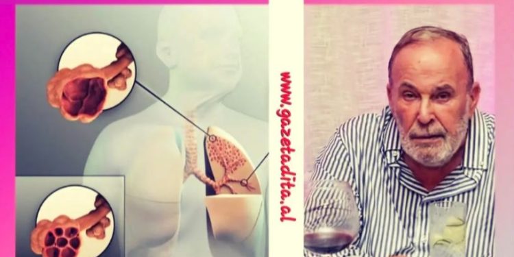 Nga se shkaktohet dhe çfarë është SPOK, sëmundja e pashërueshme që i mori jetën Fatos Nanos