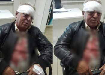 Punonjësi i Ndërmarrjes së Pastrimit rrihet barbarisht, rrezikon shikimin në syrin e djathtë (Detajet)