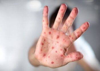 “Humbje e kujtesës dhe dëmtime të përjetshme të trurit”, mjeku tregon pasojat e fruthit