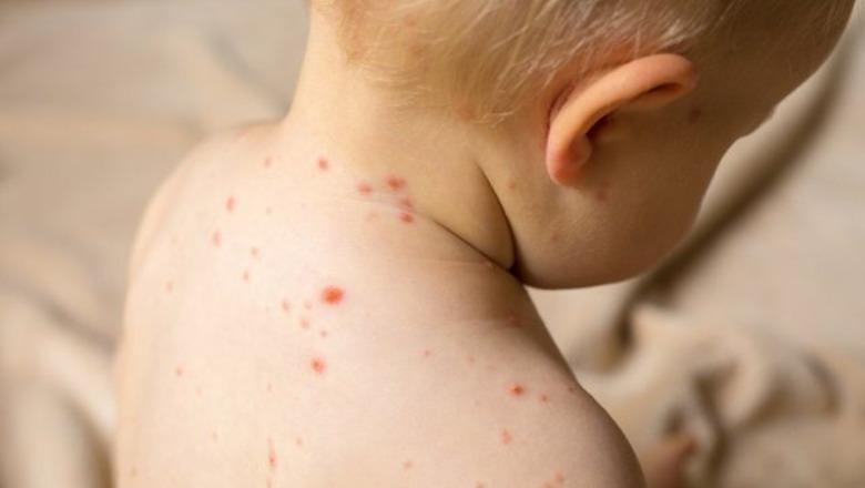 Në Shqipëri konfirmohet rasti i parë me fruth  i infektuar një fëmijë  Kishte ardhur nga  