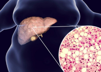 Mëlçia e dhjamosur, sëmundja e heshtur që po prek miliona njerëz