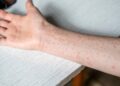 SHBA në alarm, 2 persona vdesin nga fruthi në Pensilvani, i pari në 35 vjet! Regjistrohen rreth 400 të prekur