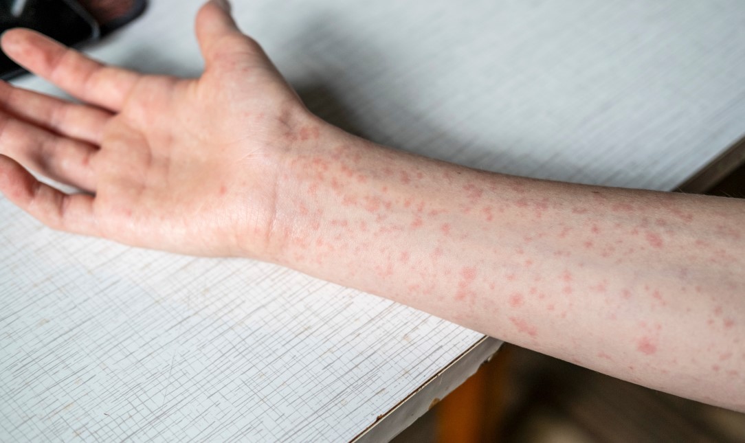SHBA në alarm  2 persona vdesin nga fruthi në Pensilvani  i pari në 35 vjet  Regjistrohen rreth 400 të prekur