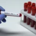 Shqipëria miraton për herë të parë planin kombëtar kundër hepatiteve virale, Rama: Synimi, parandalimi i rasteve të reja dhe ulja e kancerit të mëlçisë